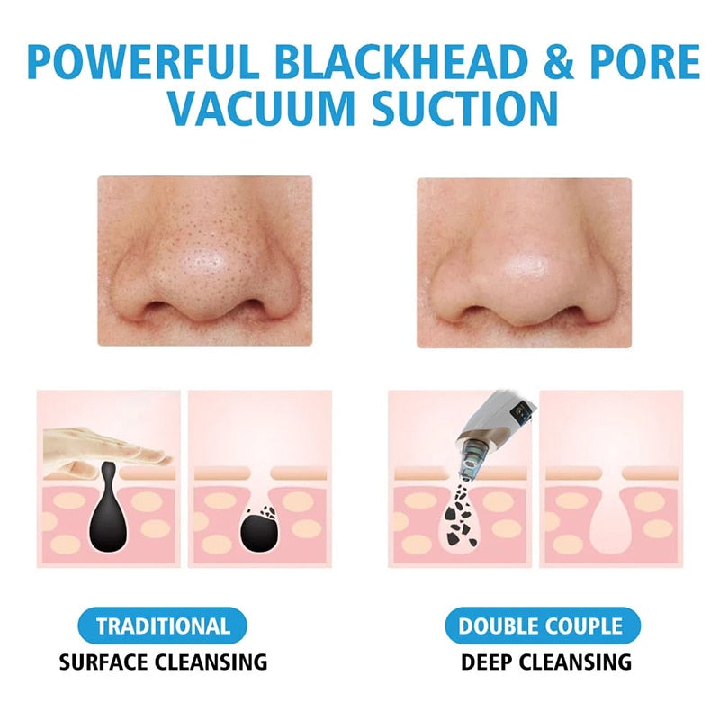 Electric Facial Blackhead Remover Vacuum Acne Spots Pore Black Dot